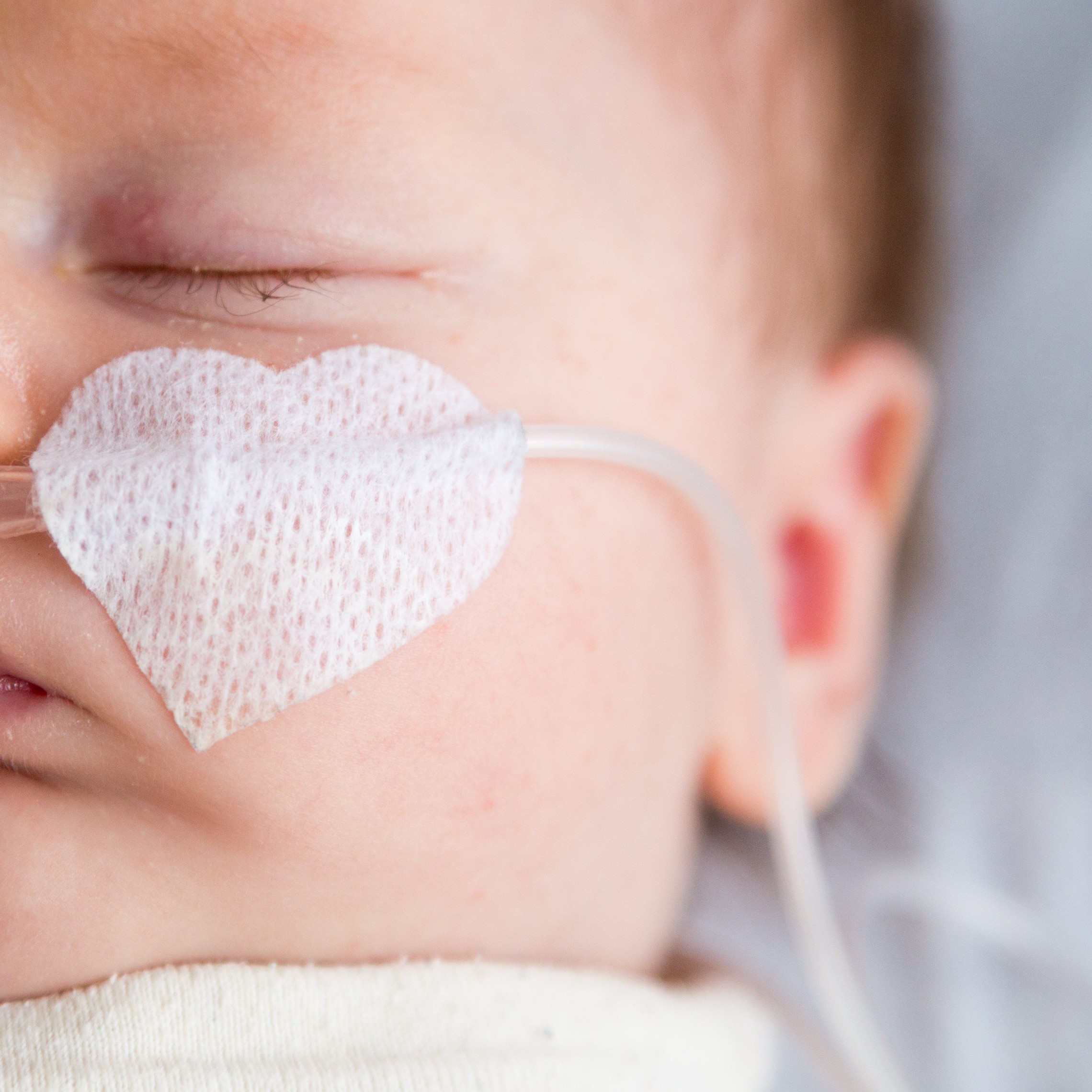 Baby Gordon receives oxygen from a nasal cannula