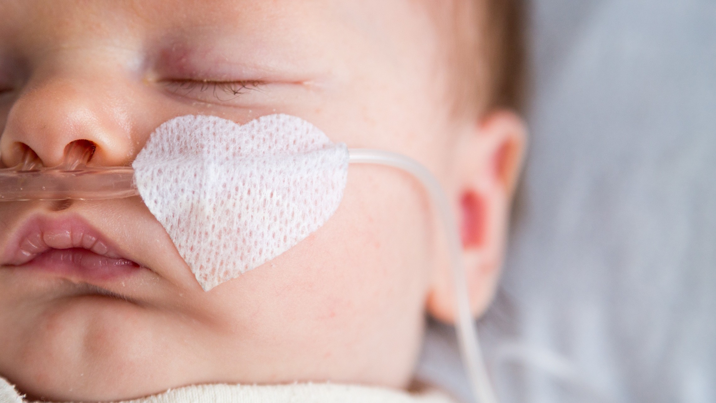 Baby Gordon receives oxygen from a nasal cannula